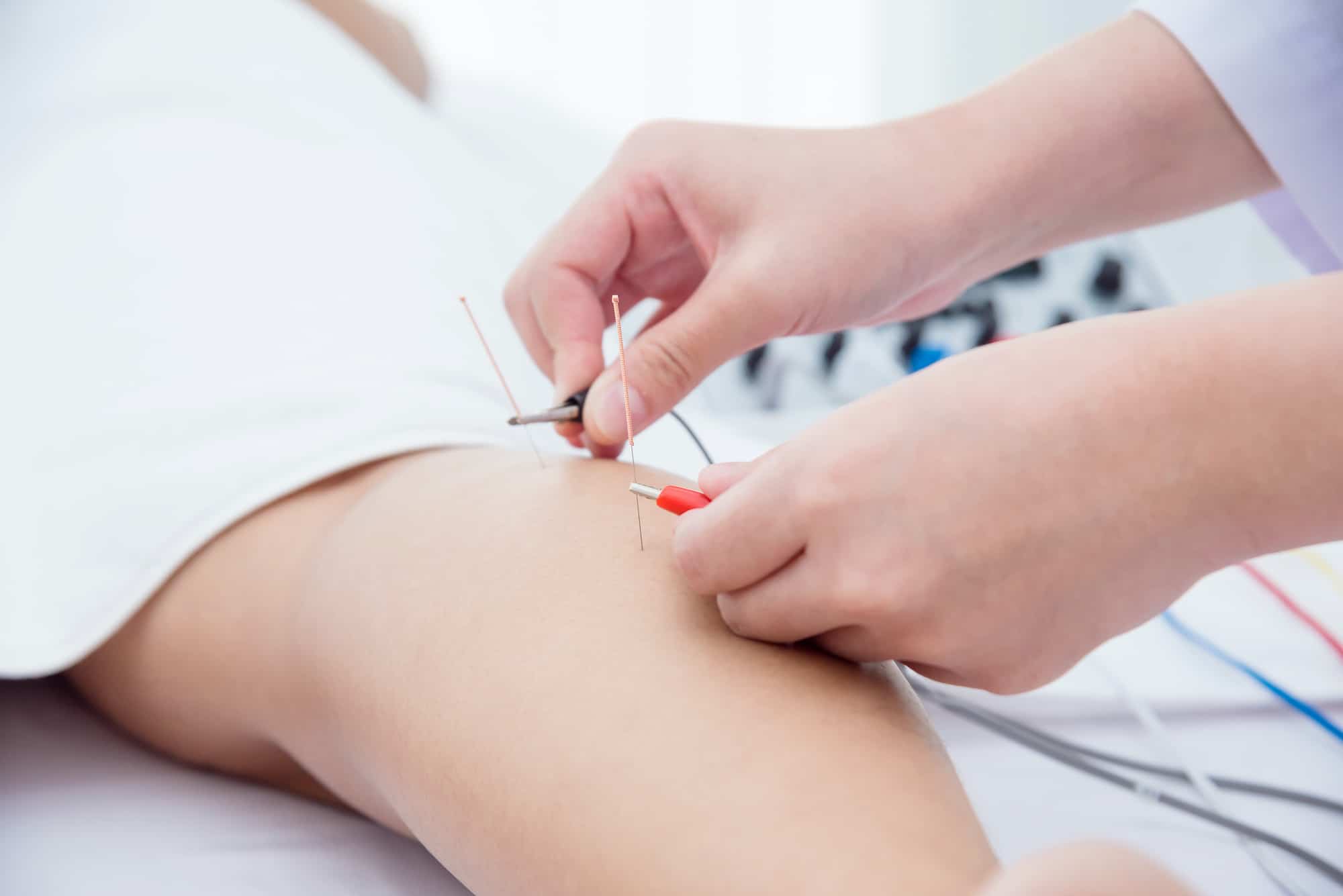 Difference Between Dry Needling And Acupuncture
