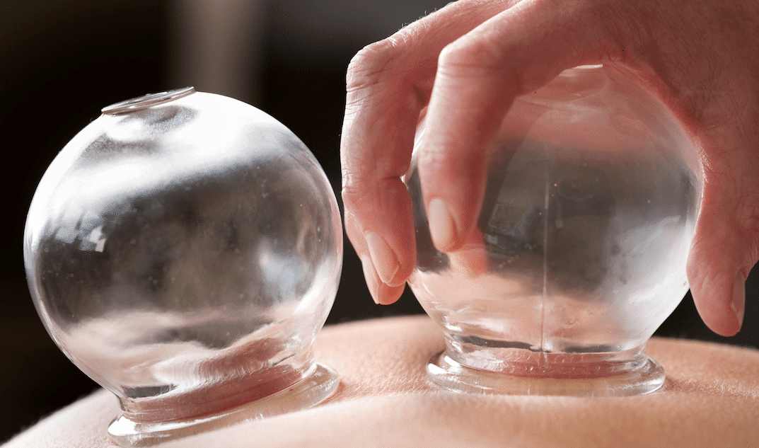 What Is Cupping Therapy? – Improving Mobility, Blood Flow and Fascial Restriction