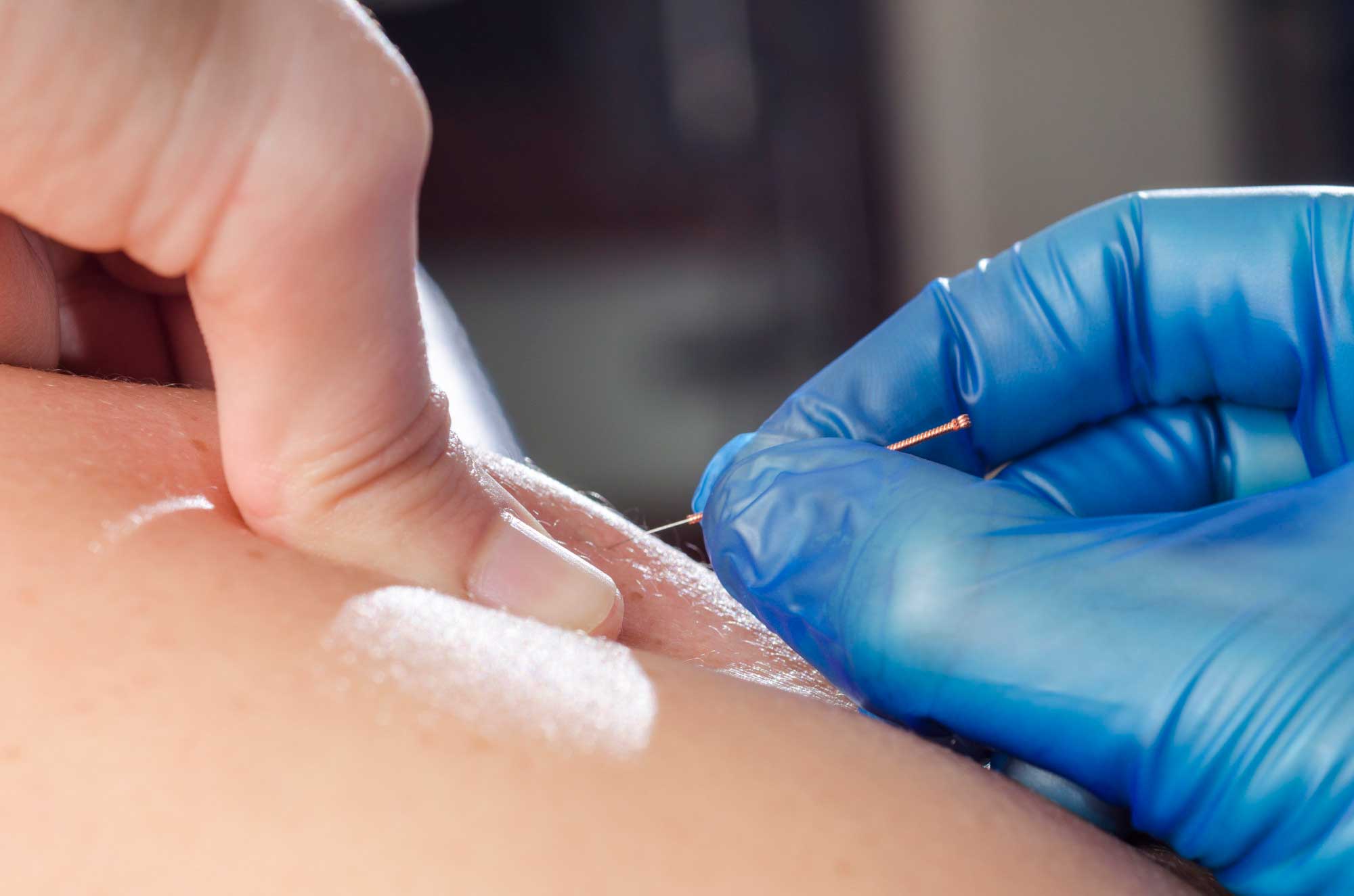 Dry Needling FAQs